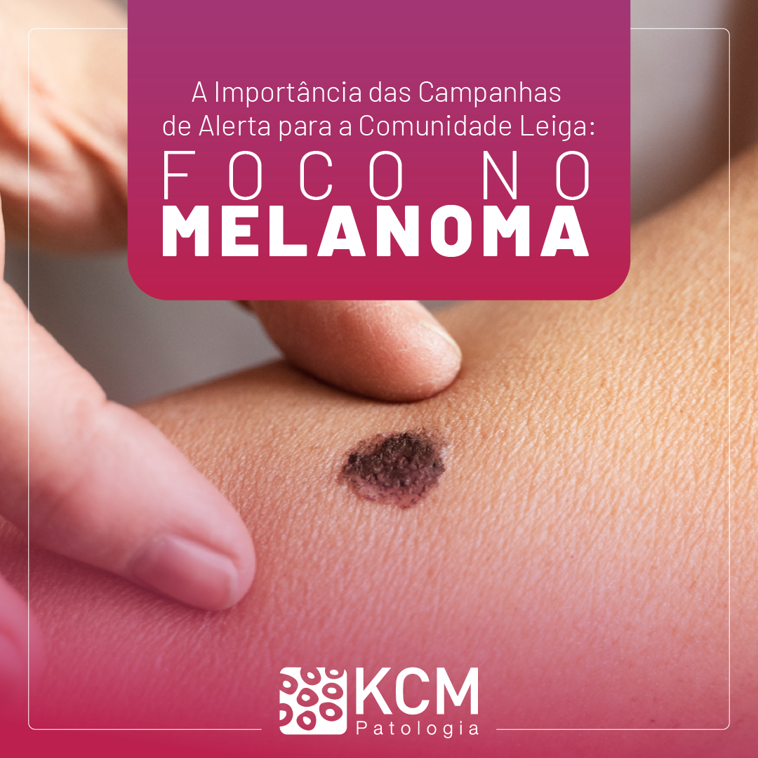 A Importância das Campanhas de Alerta para a Comunidade Leiga: Foco no Melanoma