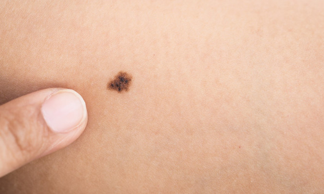 Tecnologia a serviço do diagnóstico precoce do melanoma